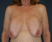 Feel Beautiful - Explant and Breast Lift 205 - Before Photo