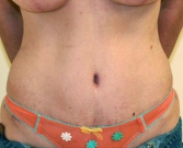 Feel Beautiful - Tummy Tuck Case 10 - After Photo