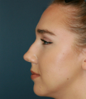 Feel Beautiful - Rhinoplasty 219 - Before Photo