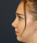 Feel Beautiful - Rhinoplasty 219 - After Photo