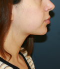 Feel Beautiful - Lipo Neck and Face - After Photo