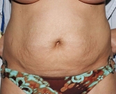 Feel Beautiful - Tummy Tuck Case 11 - Before Photo