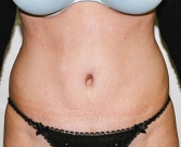 Feel Beautiful - Tummy Tuck Case 11 - After Photo
