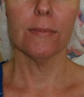 Feel Beautiful - Necklift case 8 - Before Photo