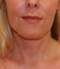 Feel Beautiful - Necklift case 8 - After Photo