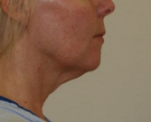 Feel Beautiful - Necklift case 8 - Before Photo