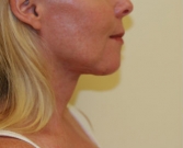 Feel Beautiful - Necklift case 8 - After Photo