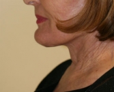 Feel Beautiful - Necklift case 9 - After Photo