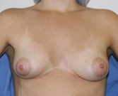 Feel Beautiful - Breast Augmentation Case 3 - Before Photo