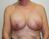 Feel Beautiful - Breast Reduction Case 1 - After Photo