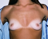 Feel Beautiful - Breast Augmentation Case 2 - Before Photo