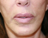 Feel Beautiful - Lips Case 12 - Before Photo